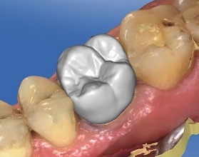 Restaurations en porcelaine CEREC