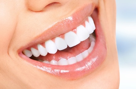 Facettes en porcelaine